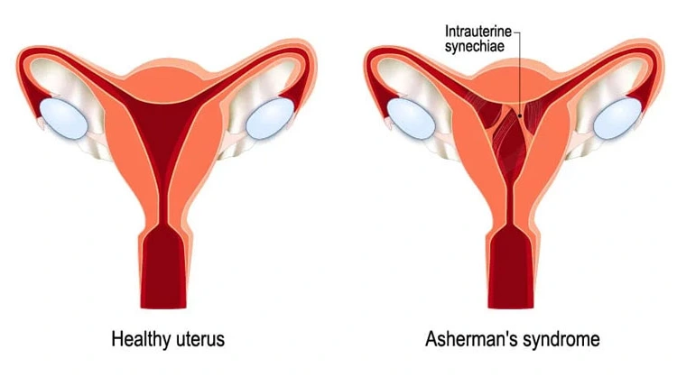 hysteroscopic adhesiolysis Hysteroscopic Polypectomy